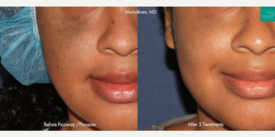 25-34 year old woman treated with PicoSure - PicoSure and PicoWay lasers used to treat melasma on a female patient by Dr. Boen.