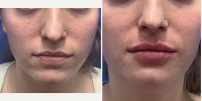25-34 year old woman treated with Lip Fillers - Female in her 20s wants increased lip volumeDetails: Lip filler to improve lip fullness to make them look prettier/more feminine and reduce upper tooth show when she smilesShort summary: Lip filler to increase lip appearance