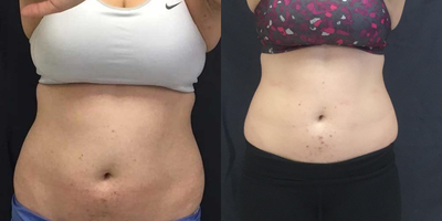 Woman treated with SculpSure - SculpSure