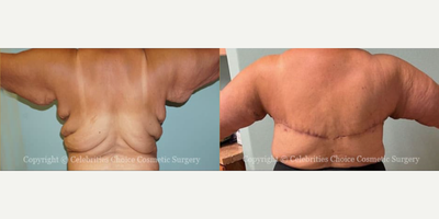 Woman treated with Body Lift, Back Lift - This patient had Circumferential breast reduction with lift, Axillary Excisions, upper back lift, and arms lift (2 months post operation)