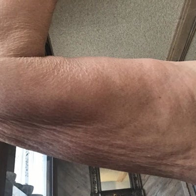 Plasma Pen To Tighten My Arms Review Realself