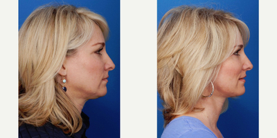 35-44 year old woman treated with Facelift - The patient presented with desires of a complete refreshed look that was dramatic, yet natural appearing.