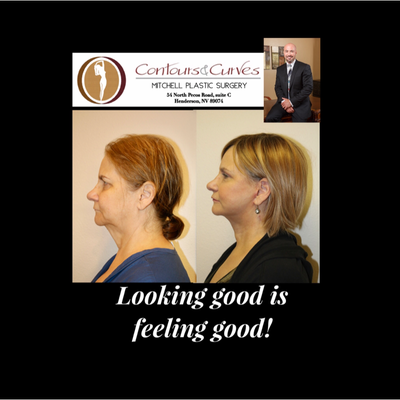 45-54 year old woman treated with Neck Lift - This pleasant patient is showing one month after undergoing a lower face and neck lift.