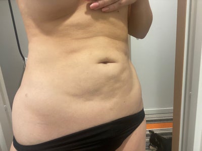 Plus size: Extended Tummy tuck with lipo on flanks - Review - RealSelf