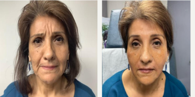 45-54 year old woman treated with Cheek Fillers, Botox, Dermal Fillers, Radiesse - Patient wanted her nasolabial fold done, i told her the issue was not her nasolabial fold but lateral cheeks and jaw that had atrophy, loss elasticity, we did not even inject the nasiolabial fold and still got the same effect