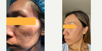 35-44 year old woman treated with MiXto Laser, Laser Resurfacing, Sculptra, Bellafill - Laser resurfacing is combined with subcision, and fillers such a sculptra And bellafill. Two treatments were performed six months apart and this is the patient one year later with significant improvement.
