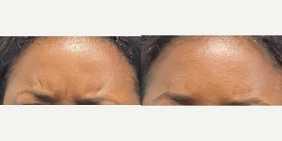 25-34 year old woman treated with Botox - Glabellar lines Botox results after 2 weeks