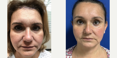 47 year old woman treated with Open Forehead lift - This patient wanted brow lift and correction of brow asymmetry as well as reduction of tall forehead. An open approach with incision placed in zig-zag fashion along the hairline was used, 2 cm of skin was removed to lower the forehead hight. Patient is shown before, immediately after and 1.5 y after forehead lowering/brow lift surgery with open approach.