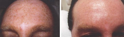 Greben peel to freckles on forehead - Source: Omniderm
