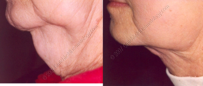 LipoDissolve injections to neck fat - 