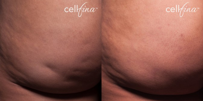 45-54 year old woman treated with Cellfina - 49-year-old female patient treated for cellulite on buttocks.