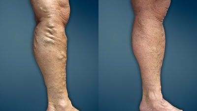 Extensive varicose veins treated with EVLT and micro-phlebectomy - This is a 61 year old woman who had been suffering with painful, swollen, achy varicose veins for 25 years. Her treatment consisted of endovenous laser ablation (EVLA) of the greater saphenous vein followed by one session of micro-phlebectomy. She began to notice improvements shortly after her treatment and reported no residual pain, discomfort, or swelling by day 4 after her last procedure. Of note, she also no longer suffers from a restless leg during the night that often made it difficult for her to sleep.