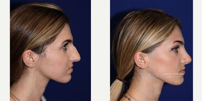 24 year old woman treated with Rhinoplasty - 24 year old woman treated with Rhinoplasty.