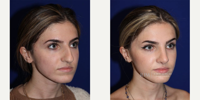 24 year old woman treated with Rhinoplasty - 24 year old woman treated with Rhinoplasty.