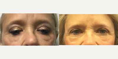 45-54 year old woman treated with Brow Lift - Brow lift procedure to raise the eyebrows.