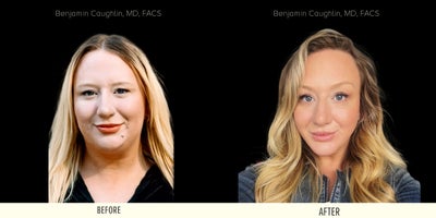 25-34 year old woman treated with Buccal Fat Removal, Chin Implant - Before & After Transformation  This young female patient sought a slimmer, more sculpted facial structure. Through Buccal Fat Removal and a Chin Implant, we achieved a beautifully balanced, natural-looking refinement. The result? A more defined, contoured look that enhances her features while maintaining a soft, harmonious appearance.