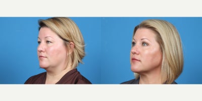 35-44 year old woman treated with Chin Liposuction - Submental liposuction