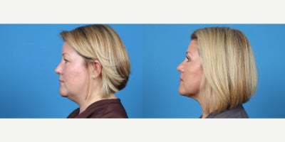 35-44 year old woman treated with Chin Liposuction - Submental liposuction