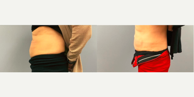 35-44 year old woman treated with Skin Rejuvenation - 35-44 year old woman treated with Skin Tightening with Bodyfx