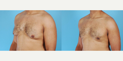 35-44 year old man treated with Male Breast Reduction - A 38 year old gentleman before and after Correction Gynecomastia with Ultrasonic Assisted Liposuction of the chest with removal of 900cc by Andrew T. Lyos M.D FACS.