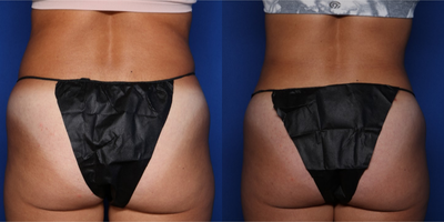 35-44 year old woman treated with Liposuction - 37 year old female shown 6 weeks after BodyTite liposuction to her abdomen and flanks (lipo 360). She had 1.5 L removed.