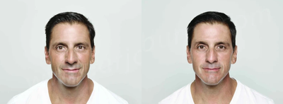 Man treated with Dysport - Man treated with 50 units of Dysport to glabella and 3.0 CC of Restylane to nasolabial folds