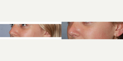 18-24 year old woman treated with Rhinoplasty - Age: 18 - 29. Woman treated with Rhinoplasty