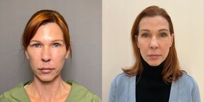 45-54 year old woman treated with Brow Lift - Bilateral Endoscopic browlift