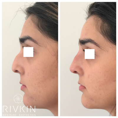 Non Surgical Nose Job - This patient had a down turned nose but did not want to go through with surgery. filler is placed in columns on the upper part of the bridge of her nose creating a straight bridge that is enhanced and also creates an illusion that the nose is smaller than it is!