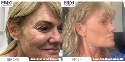 45-54 year old woman treated with Deep Plane Facelift, Neck Lift, Forehead Reduction, Double Eyelid Surgery, Rhinoplasty, Facial - 45-54 year old woman treated with Deep Plane Facelift, Neck Lift, Forehead Reduction, Double Eyelid Surgery, Rhinoplasty, Facial Fat Transfer