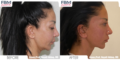 45-54 year old woman treated with Deep Plane Facelift, Mini Neck Lift, Facial Fat Transfer - 45-54 year old woman treated with Deep Plane Facelift, Mini Neck Lift, Facial Fat Transfer