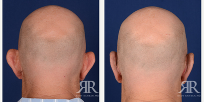 Man treated with Ear Surgery - Man treated with Ear Surgery
