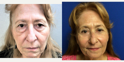 65-74 year old woman treated with Eyelid Surgery, Laser Resurfacing - Upper Lid, Lower Lid Blepharoplasty, Co2 full face resurfacing