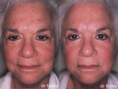 Fraxel Laser Treatment of Age Spots - 68 year old female who was unhappy with the brown age spots on her face. She is shown 7 months following a series of four Fraxel DUAL 1550/1927 laser treatments.
