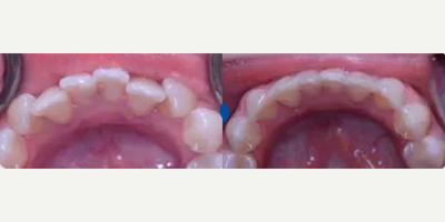 Woman treated with Invisalign - Woman treated with Invisalign