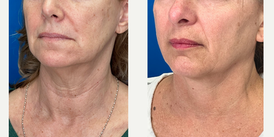 Woman treated with Endolift - Woman treated with Endolift.