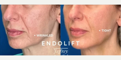 Woman treated with Endolift - Woman treated with Endolift.