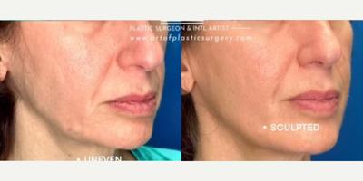 Woman treated with Endolift - Woman treated with Endolift.