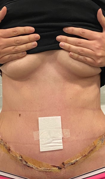 FAILED Muscle Repair? Edousin Scar Strips GIVEAWAY  6 Month Tummy Tuck  Update #plasticsurgery 