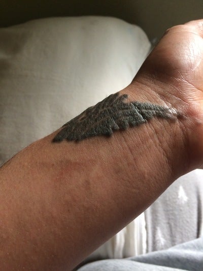Is Raised and Itching Skin Normal After Tattoo Removal ...