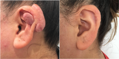 25-34 year old woman treated with Biocorneum - Dr. Karamanoukian performed a keloid scar removal surgery to reduce keloid bulk and restore the natural contour of the ear. Dr. Raffy Karamanoukian uses a HIDEF approach to keloid and scar management.