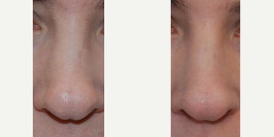 Non-surgical Rhinoplasty Before & After: Correction of Vertical Cleft at Nasal Tip - Our lovely patient was dissatisfied with the appearance of the visible vertical cleft between her nasal tip and lower lateral cartilages, directly along the midline. She was otherwise pleased with the overall appearance of her nose. The after photos demonstrate the results of a single, permanent, non-surgical nose job treatment using microdroplet Silikon-1000. The results are subtle, but upon closer inspection, you can see a marked improvement in the appearance of the cleft. We injected from her columella up to the top of her nasal tip. Our patient is thrilled with the results, and this treatment offers a lovely alternative to rhinoplasty surgery for a relatively common condition, especially in people with thin nasal skin and firm underlying nasal tip cartilages.