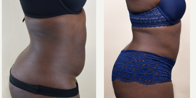 25-34 year old woman treated with Liposuction - This patient wanted liposuction to remove exercise-resistant fat.