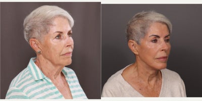 75 and up year old woman treated with Facelift, Double Eyelid Surgery, Facial Fat Transfer, Botox, Dermal Fillers, Laser Resurfa - Facelift, Upper & Lower Blepharoplasty, Fat Grafting by Dr. Thompson. Contour TRL, Botox, Dermal Fillers, and Hydrafacial. 3 years post-operative.