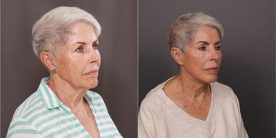 75 and up year old woman treated with Facelift, Double Eyelid Surgery, Facial Fat Transfer, Laser Resurfacing, Botox, Dermal Fil - Facelift, Upper & Lower Blepharoplasty, Fat Grafting by Dr. Thompson. Contour TRL, Botox, Dermal Fillers, and Hydrafacial. 3 years post-operative.