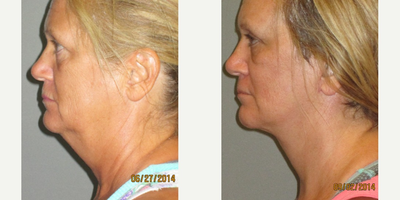 50 year old woman treated with Lifestyle Lift - This young woman presented to us to address the fullness under her chin that she had since she was in her 30's.  She was also unhappy about the loss of definition in her jawline and lack of profile (given her prominent chin).  After evaluation and discussion we decided to perform a Lifestyle Lift.  This procedure is, in essence, a Lower Facelift and Necklift that was performed under local anesthesia (with oral sedation with valium) in our office surgical suite.  Post-procedure we can see the significant improvement in both her profile and jawline.  The overall previous heaviness of her neck has been significantly improved, while maintaining a natural, healthy, and unoperated appearance.