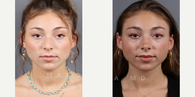 Woman treated with Rhinoplasty, Septoplasty - Transformative Septorhinoplasty by Dr James Marotta. As you can see by the reel posted, the patient is delighted to with her results! Confidence soaring with a beautifully refined nose and improved breathing.