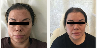 Woman treated with Rejuvapen - Woman treated with Lip Fillers.
