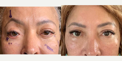 55-64 year old woman treated with Eyelid Surgery, Eyelid Retraction Repair - Secondary (revision) blepharoplasty with eyelid retraction repair: endoscopic subperiostal midfacelift, hard palate mucosa spacer graft, lateral canthoplasty, fat injection