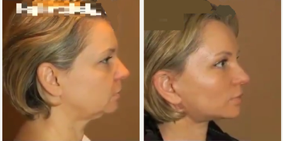 Woman treated with Neck Lift - Woman treated with Neck Lift